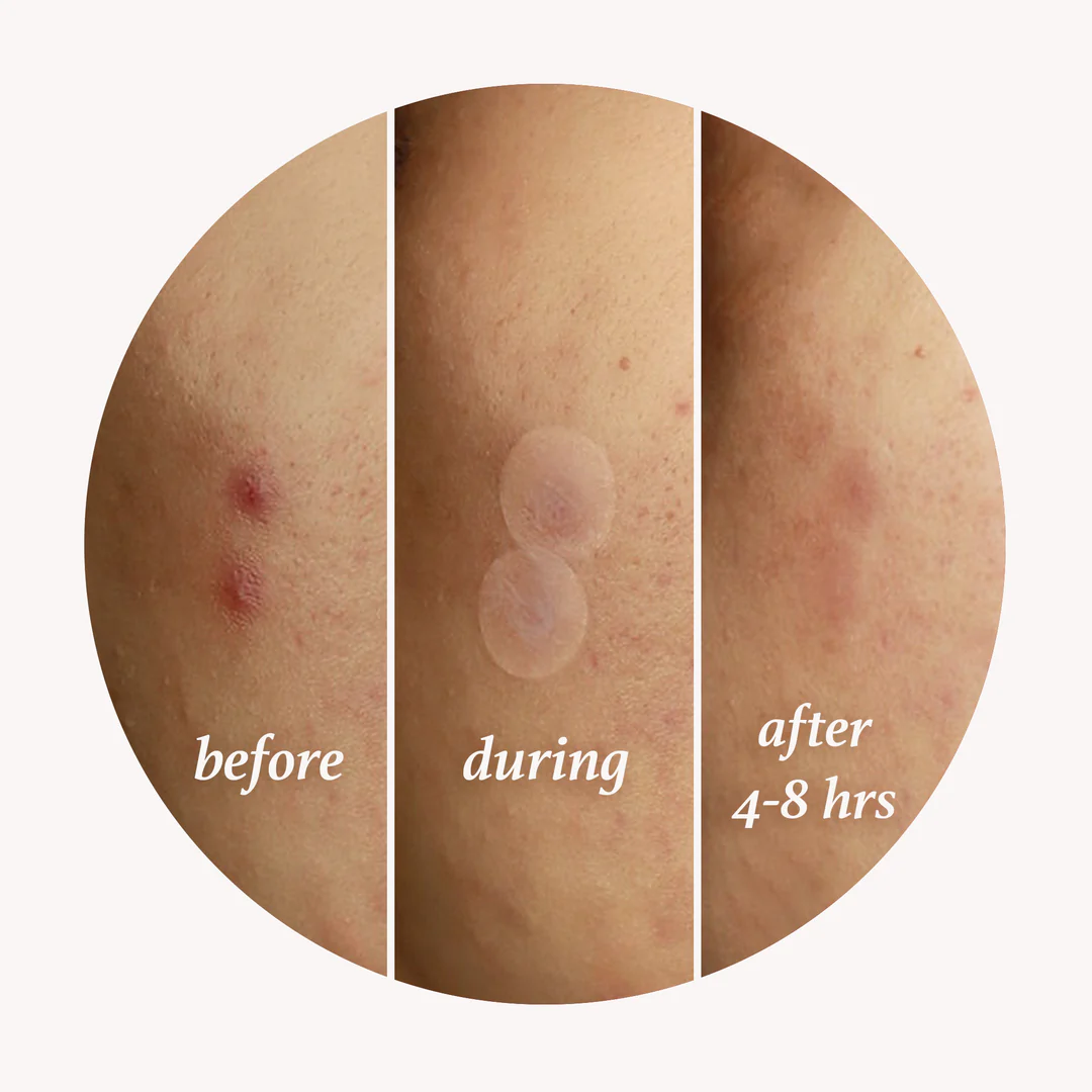 Pimple Patches - Image 5
